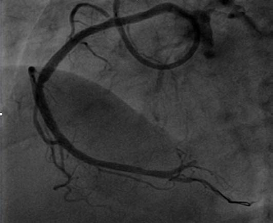 Percutaneous Coronary Intervention in Chronic Total Occlusion of Anomalous Right Coronary Artery