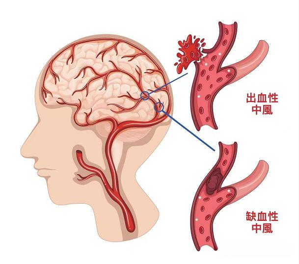 2015~2019 年中国居民脑卒中发病与死亡特征分析